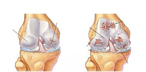 deformáló artrózisa a csípőízület azt a lábak combcsontjeinek kezelése